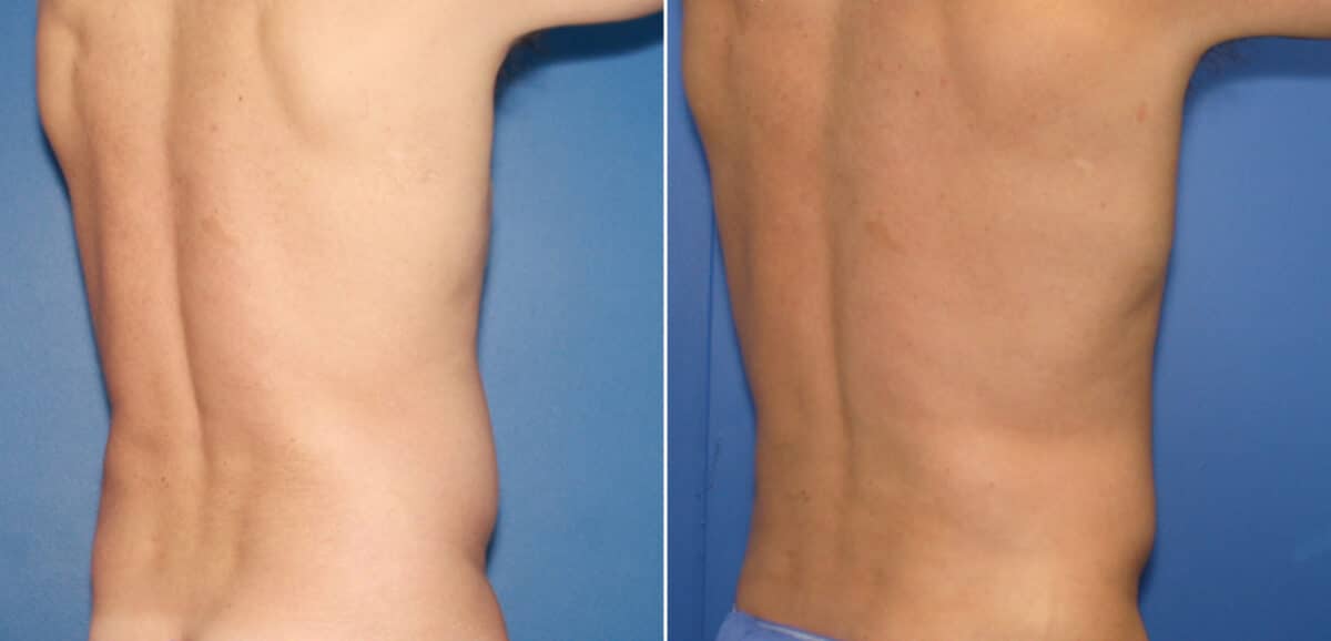 Liposuction Before and After Photos in New York, NY, Patient 16357