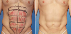 Liposuction Before and After Photos in New York, NY, Patient 16404