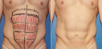 Liposuction Before and After Photos in New York, NY, Patient 16404