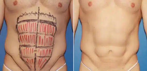 Liposuction Before and After Photos in New York, NY, Patient 16404