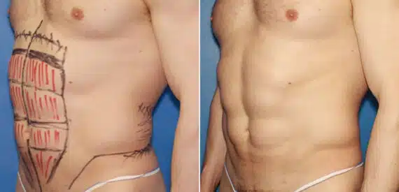 Liposuction Before and After Photos in New York, NY, Patient 16404