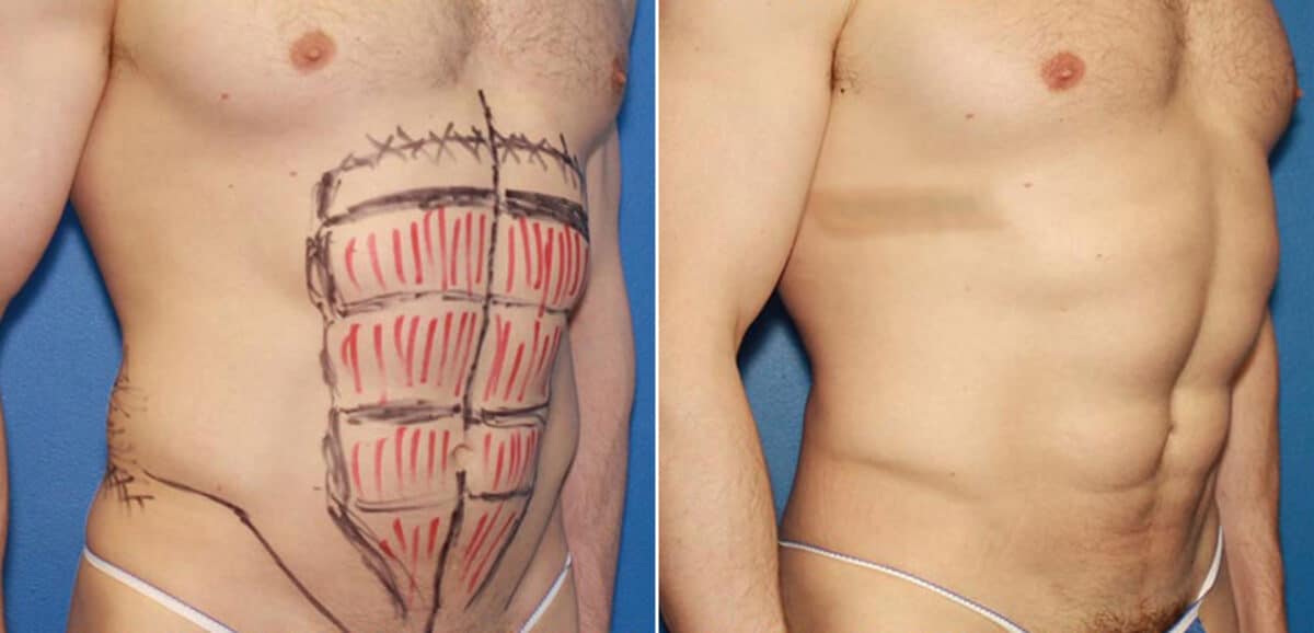 Liposuction Before and After Photos in New York, NY, Patient 16404