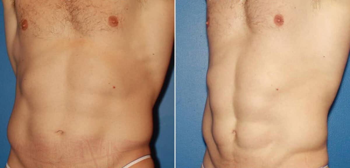 Liposuction Before and After Photos in New York, NY, Patient 16404