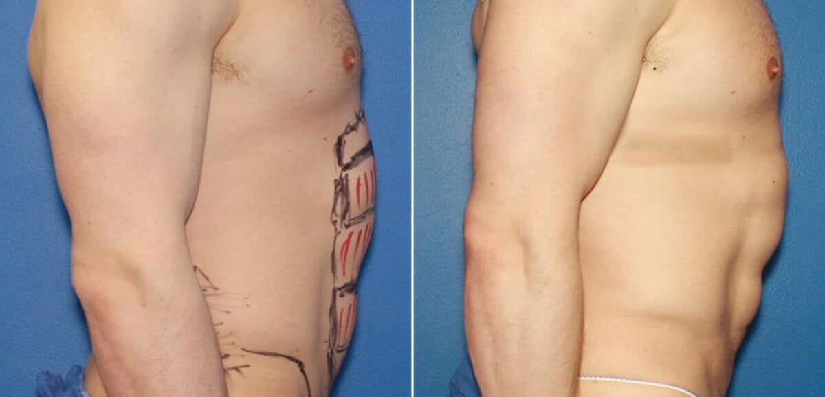 Liposuction Before and After Photos in New York, NY, Patient 16404