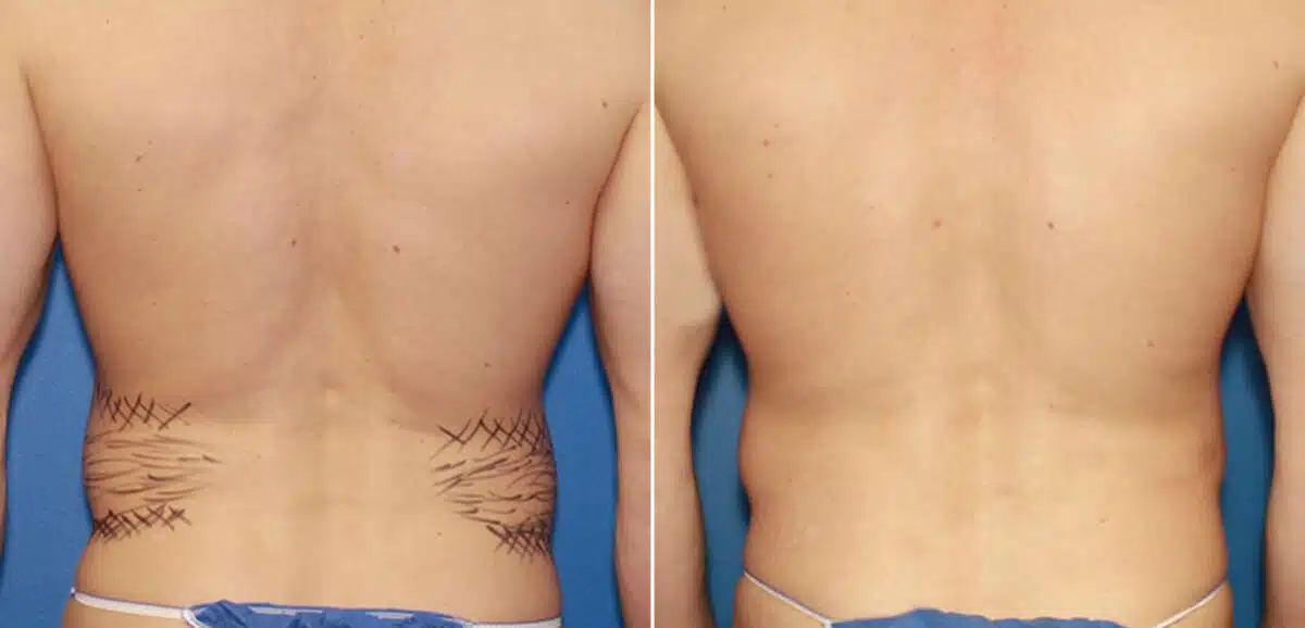 Liposuction Before and After Photos in New York, NY, Patient 16404
