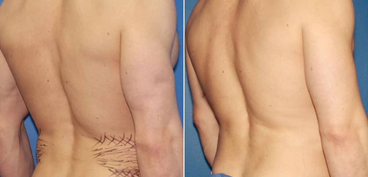 Liposuction Before and After Photos in New York, NY, Patient 16404