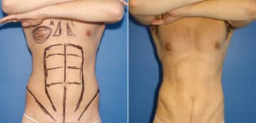 Liposuction Before and After Photos in New York, NY, Patient 16422