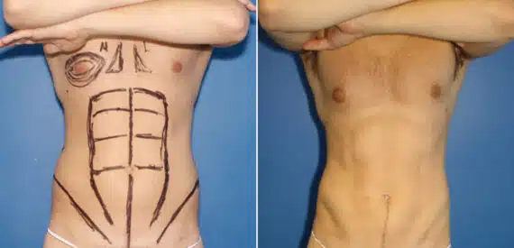 Liposuction Before and After Photos in New York, NY, Patient 16422