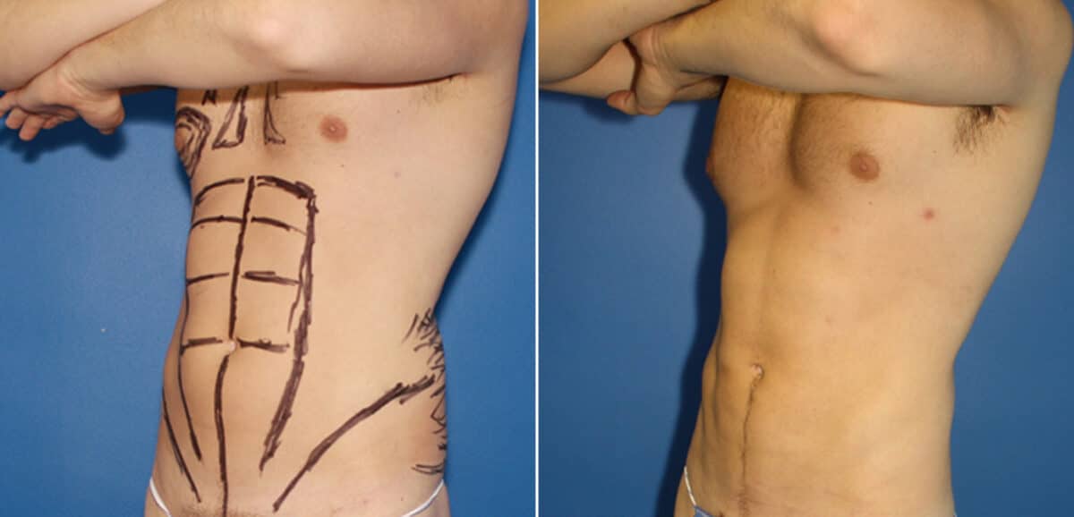 Liposuction Before and After Photos in New York, NY, Patient 16422