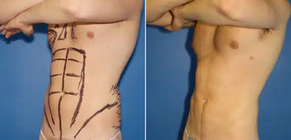 Liposuction Before and After Photos in New York, NY, Patient 16422