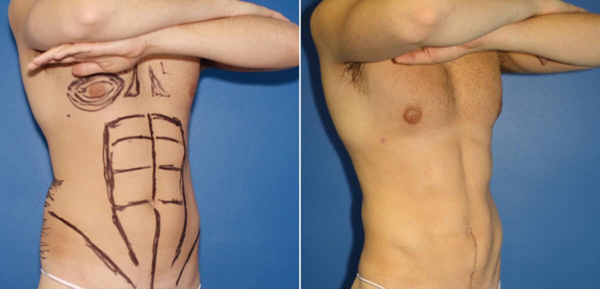 Liposuction Before and After Photos in New York, NY, Patient 16422