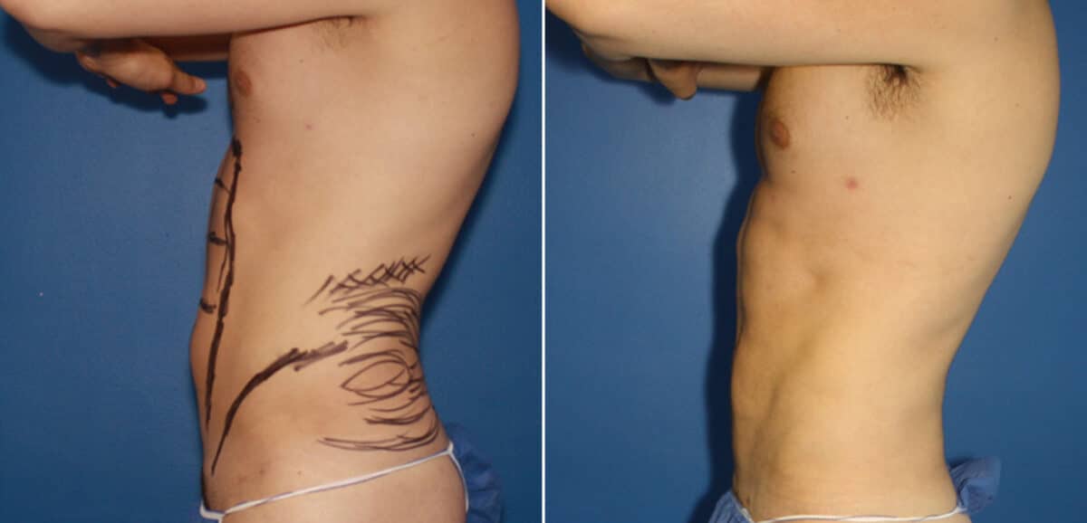 Liposuction Before and After Photos in New York, NY, Patient 16422
