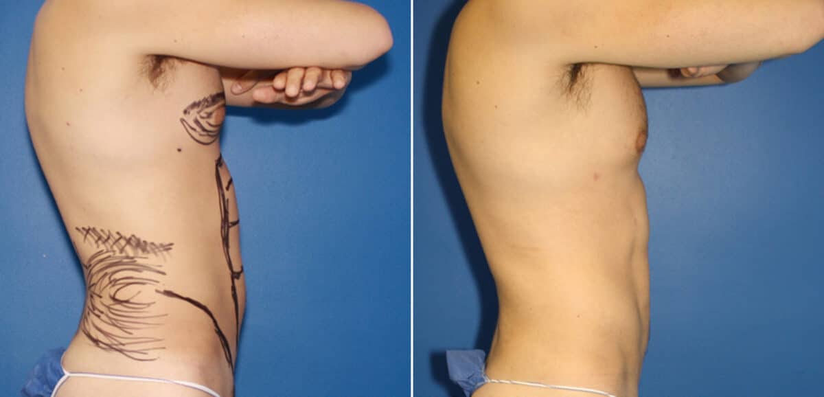 Liposuction Before and After Photos in New York, NY, Patient 16422
