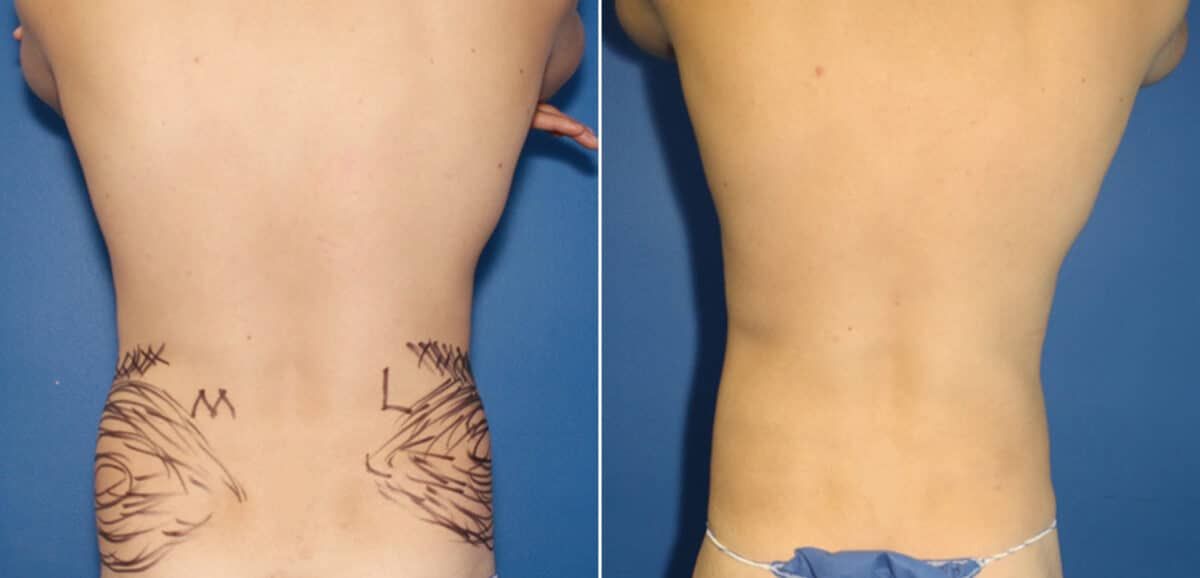 Liposuction Before and After Photos in New York, NY, Patient 16422