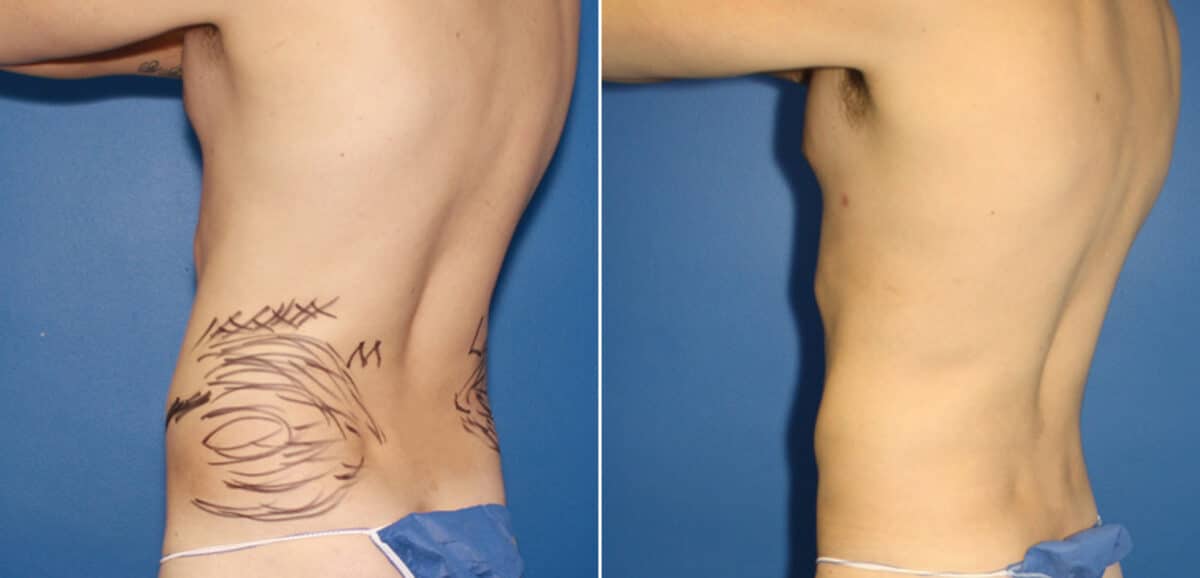 Liposuction Before and After Photos in New York, NY, Patient 16422