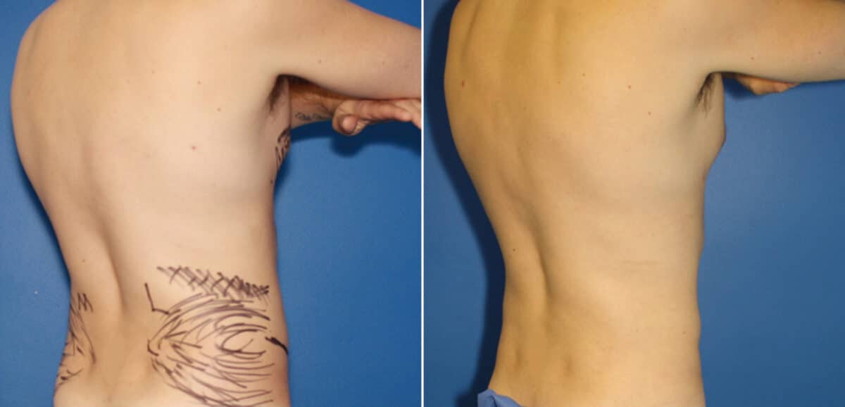 Liposuction Before and After Photos in New York, NY, Patient 16422