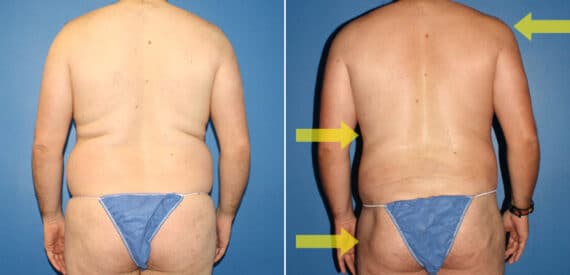 Torso Tuck Before and After Photos in New York, NY, Patient 15903