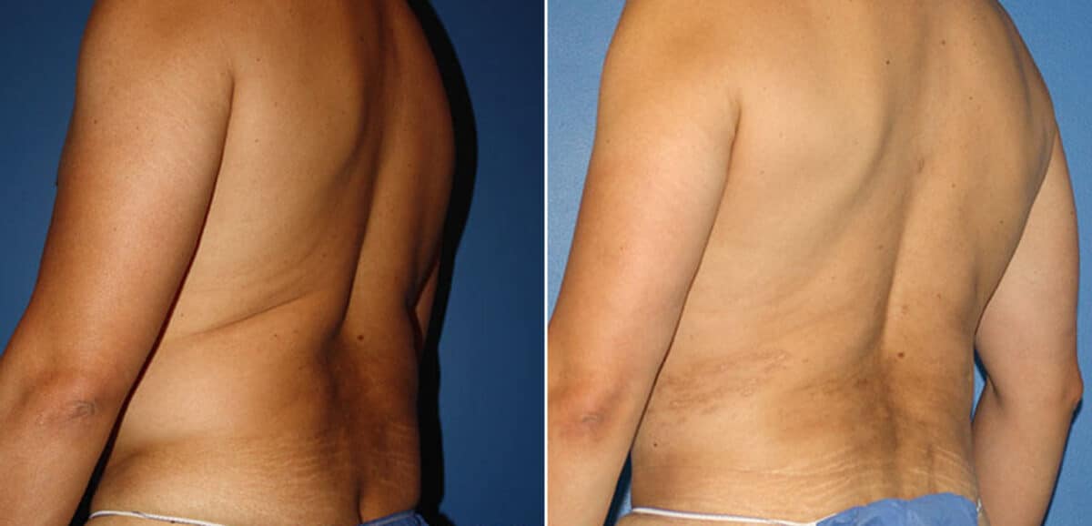 Torso Tuck Before and After Photos in New York, NY, Patient 15928