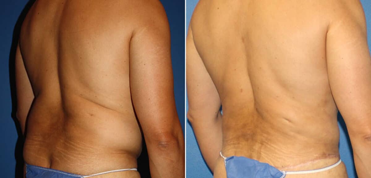 Torso Tuck Before and After Photos in New York, NY, Patient 15928