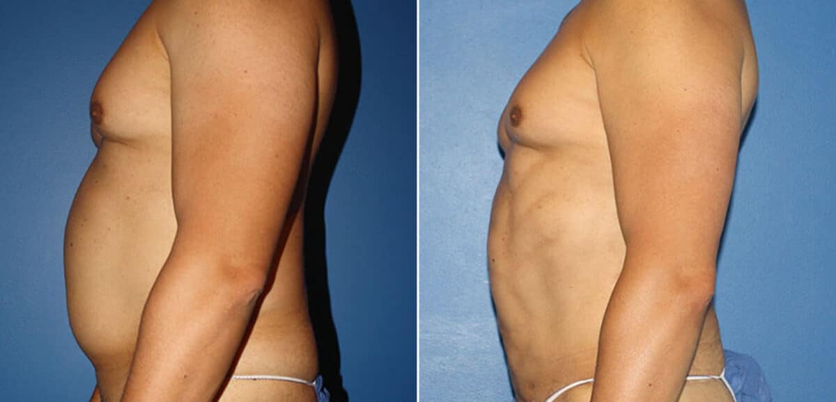 Torso Tuck Before and After Photos in New York, NY, Patient 15928