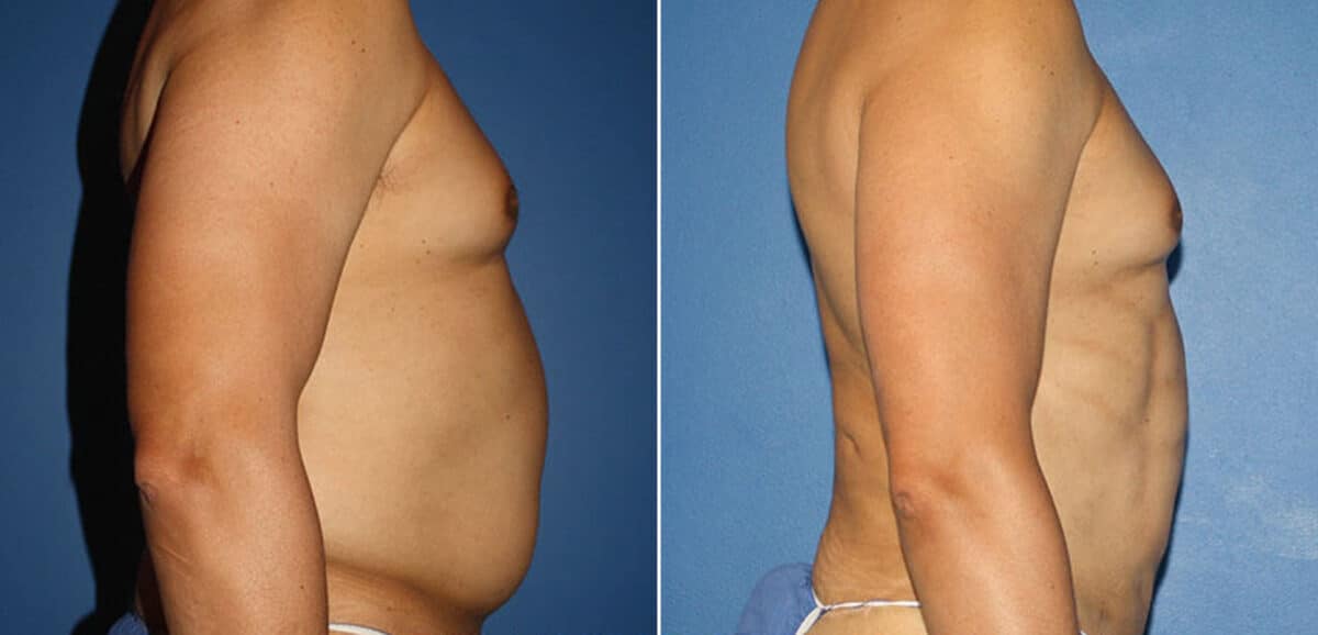 Torso Tuck Before and After Photos in New York, NY, Patient 15928