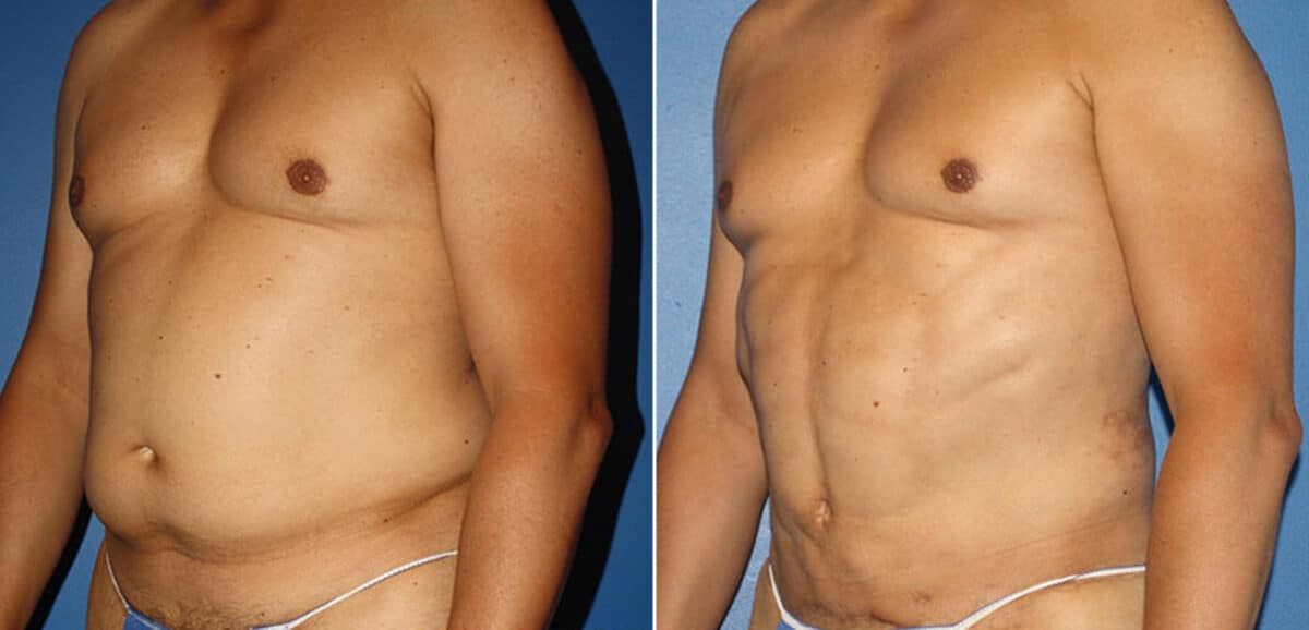 Torso Tuck Before and After Photos in New York, NY, Patient 15928