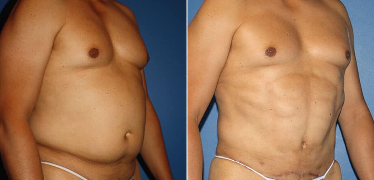 Torso Tuck Before and After Photos in New York, NY, Patient 15928