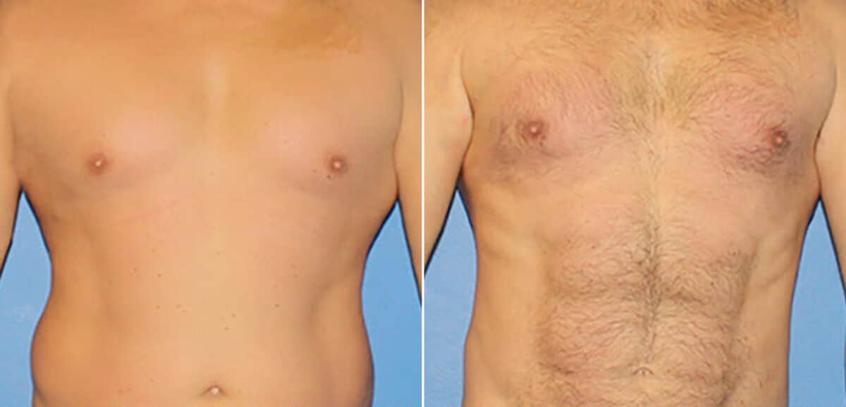 Torso Tuck Before and After Photos in New York, NY, Patient 15953