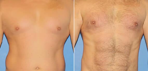 Torso Tuck Before and After Photos in New York, NY, Patient 15953