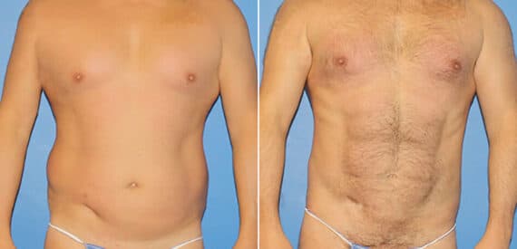 Torso Tuck Before and After Photos in New York, NY, Patient 15953