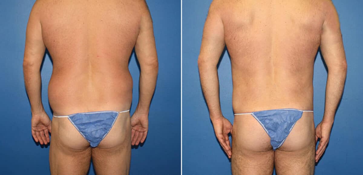 Torso Tuck Before and After Photos in New York, NY, Patient 15953