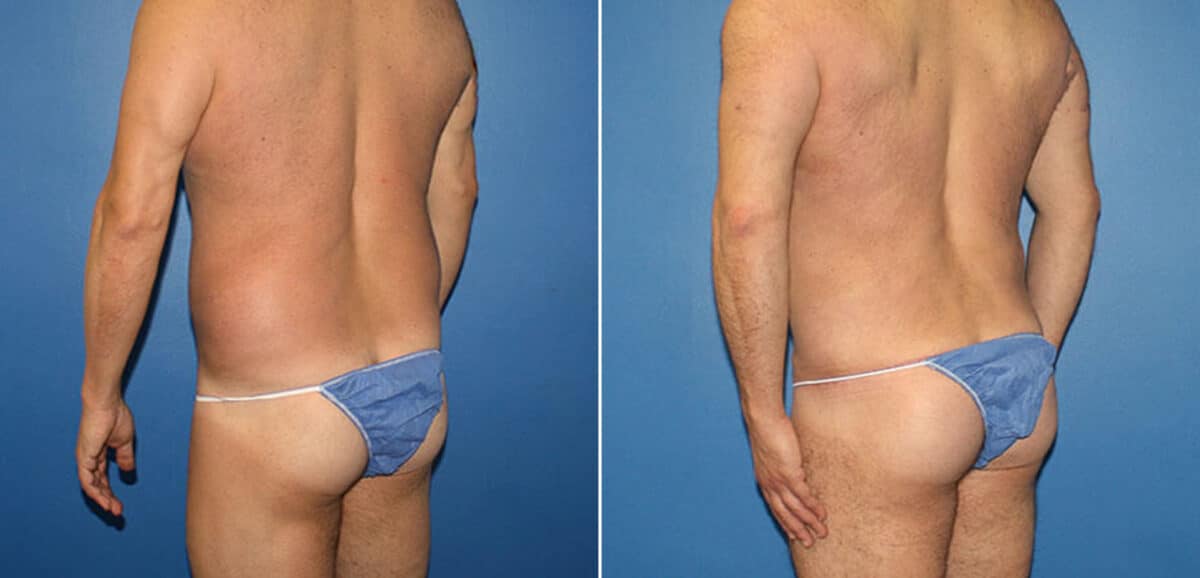 Torso Tuck Before and After Photos in New York, NY, Patient 15953