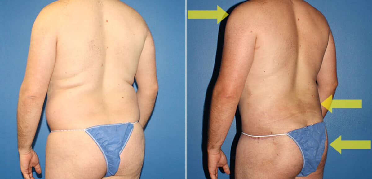 Torso Tuck Before and After Photos in New York, NY, Patient 15903
