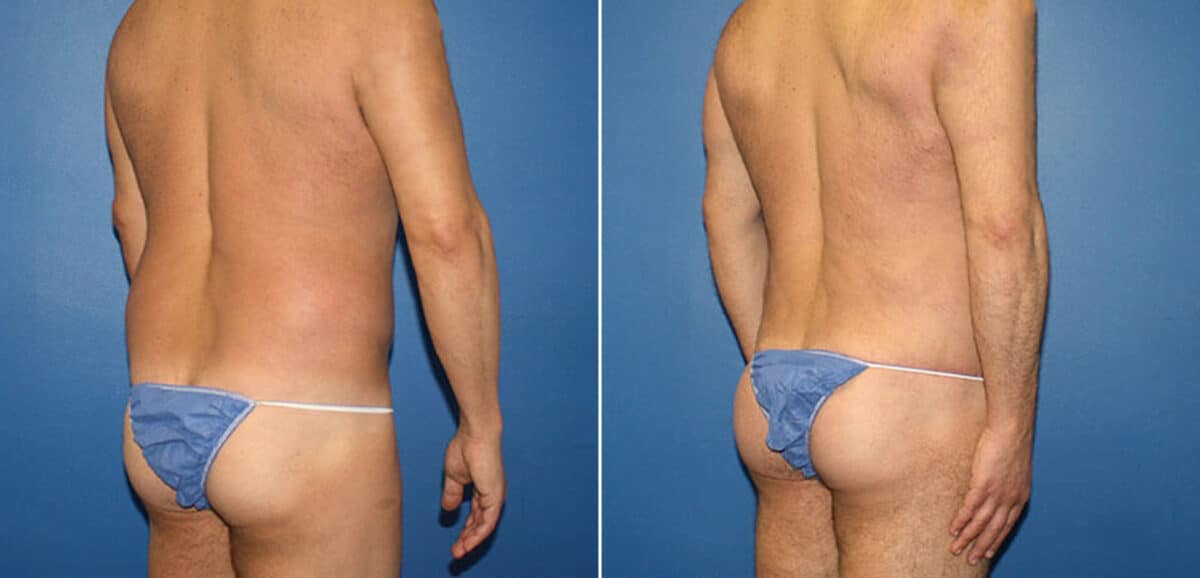 Torso Tuck Before and After Photos in New York, NY, Patient 15953