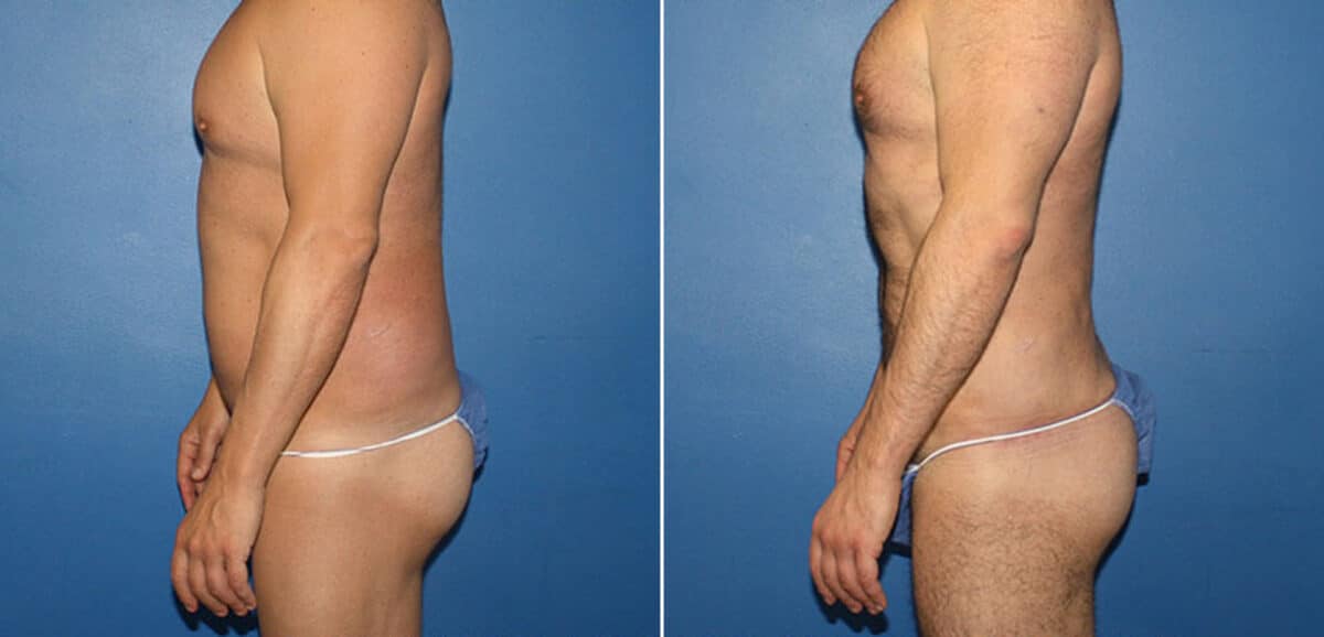 Torso Tuck Before and After Photos in New York, NY, Patient 15953