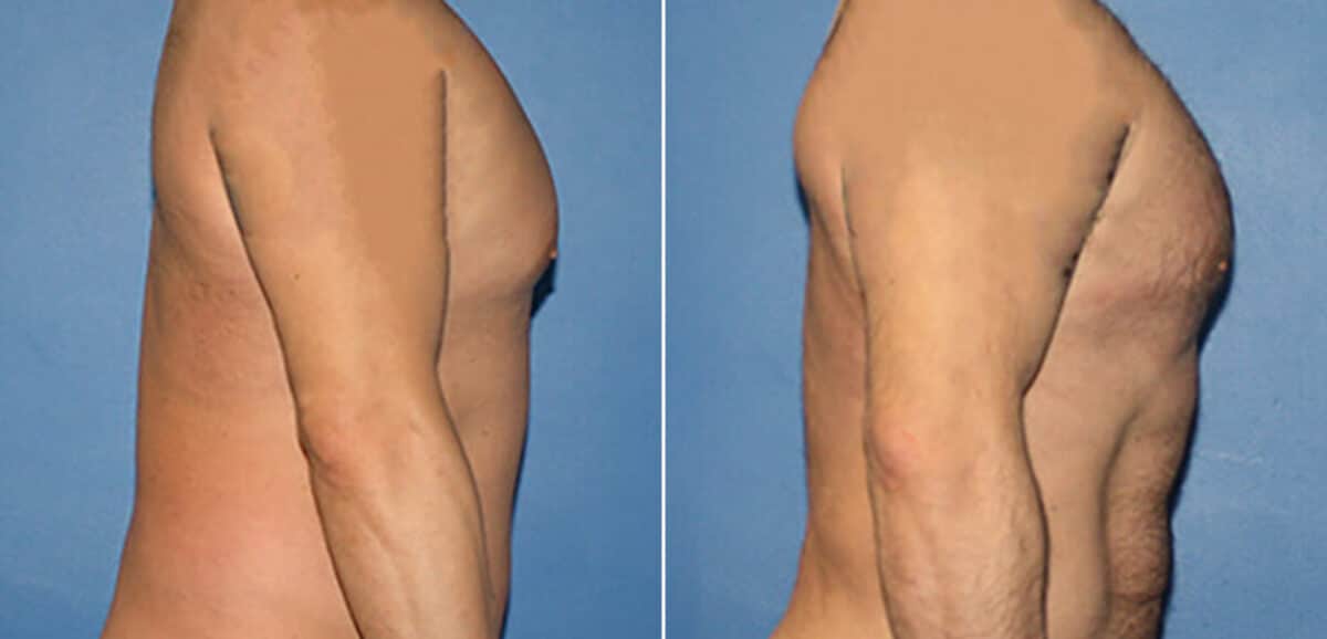Torso Tuck Before and After Photos in New York, NY, Patient 15953