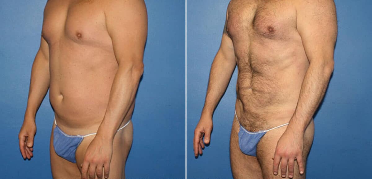 Torso Tuck Before and After Photos in New York, NY, Patient 15953