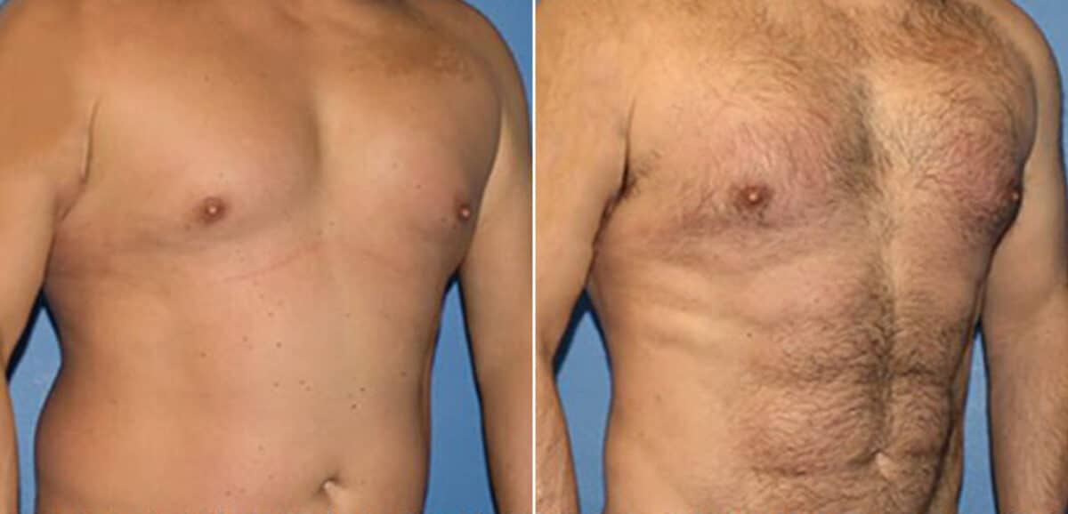 Torso Tuck Before and After Photos in New York, NY, Patient 15953