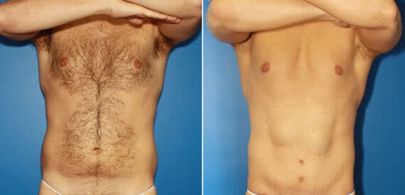 Torso Tuck Before and After Photos in New York, NY, Patient 15981