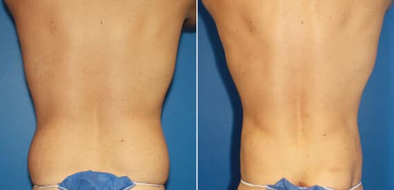 Torso Tuck Before and After Photos in New York, NY, Patient 15981