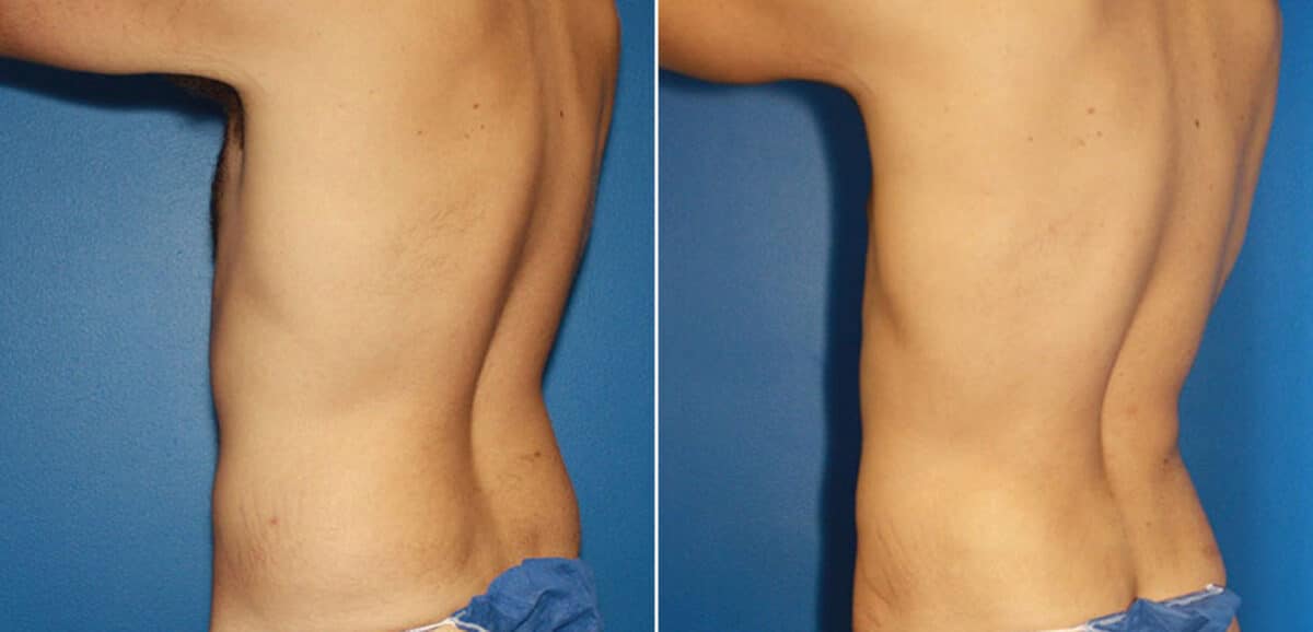 Torso Tuck Before and After Photos in New York, NY, Patient 15981