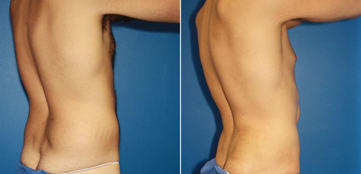 Torso Tuck Before and After Photos in New York, NY, Patient 15981