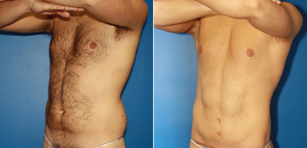 Torso Tuck Before and After Photos in New York, NY, Patient 15981