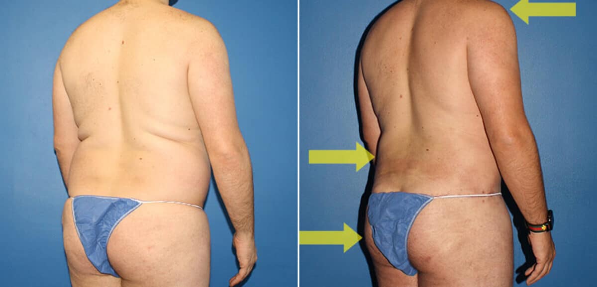 Torso Tuck Before and After Photos in New York, NY, Patient 15903