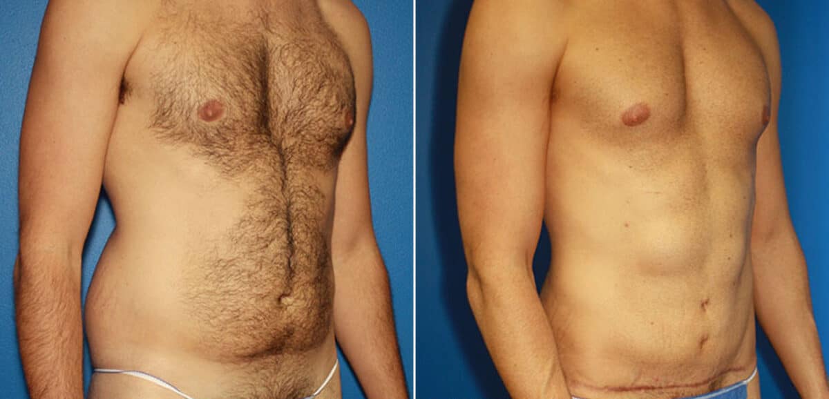 Torso Tuck Before and After Photos in New York, NY, Patient 15981