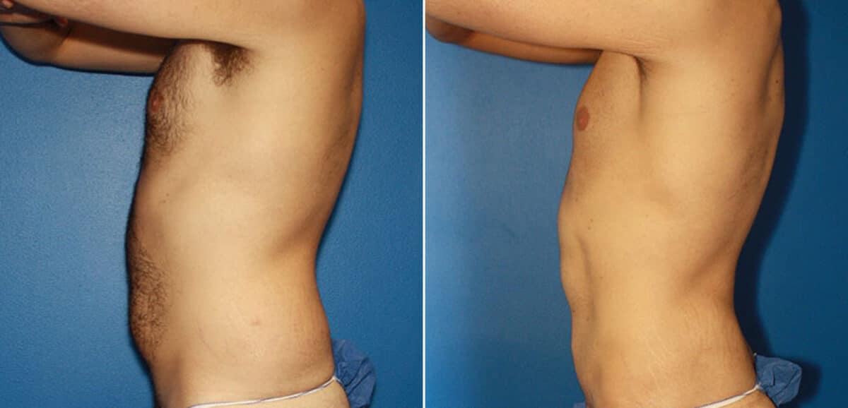 Torso Tuck Before and After Photos in New York, NY, Patient 15981