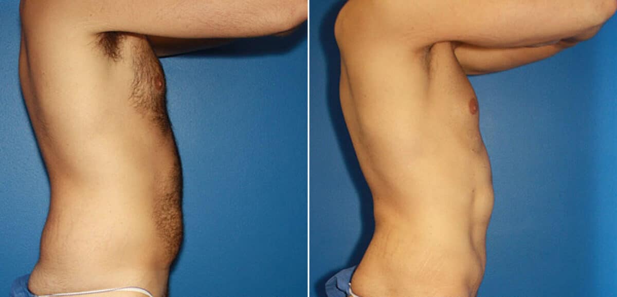 Torso Tuck Before and After Photos in New York, NY, Patient 15981