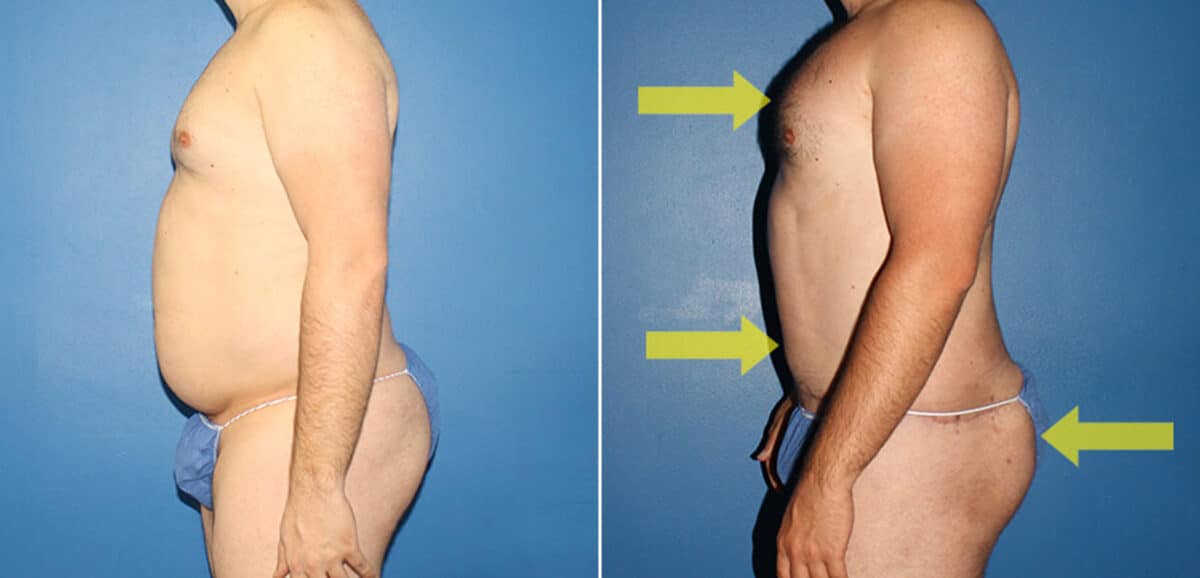 Torso Tuck Before and After Photos in New York, NY, Patient 15903