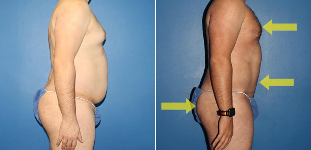 Torso Tuck Before and After Photos in New York, NY, Patient 15903