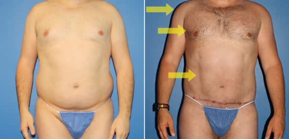 Torso Tuck Before and After Photos in New York, NY, Patient 15903